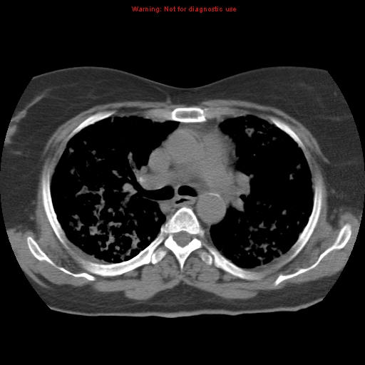 Bronchoalveolar carcinoma (Radiopaedia 13224-13233 Axial non-contrast 18).jpg