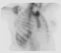File:Bronchoalveolar carcinoma (Radiopaedia 13224-13234 A 10).jpg