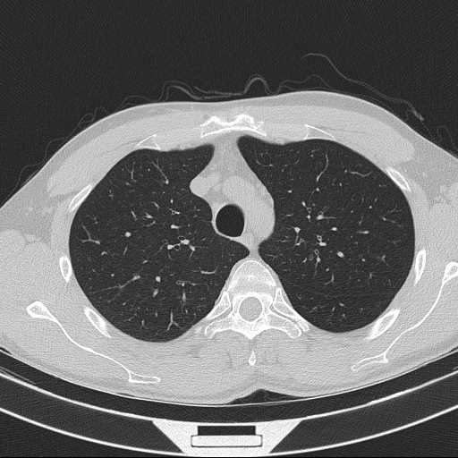Bronchocele (Radiopaedia 60676-68429 Axial lung window 18).jpg