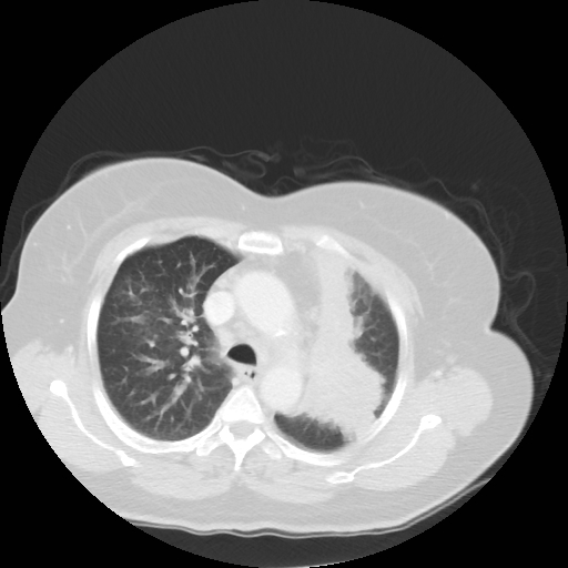 Bronchogenic carcinoma (Radiopaedia 73497-84262 Axial lung window 27).jpg