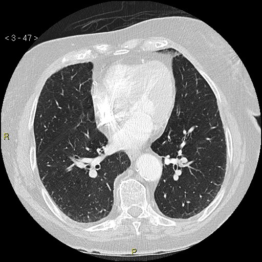 Bronchogenic carcinoma as an incidental finding (Radiopaedia 16453-16130 Axial lung window 47).jpg