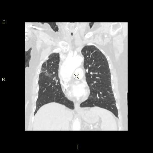 File:Bronchogenic carcinoma as an incidental finding (Radiopaedia 16453-16130 Coronal lung window 25).jpg