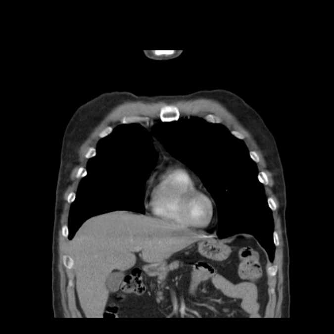 Bronchogenic carcinoma with upper lobe collapse (Radiopaedia 29297-29726 D 17).jpg