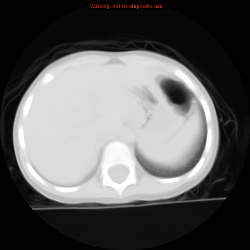 File:Bronchogenic cyst (Radiopaedia 9372-10063 Axial lung window 16).jpg