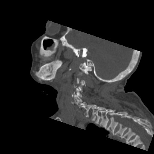 File:Brown tumor with secondary hyperparathyroidism (Radiopaedia 23591-23705 B 1).jpg