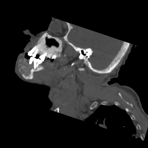File:Brown tumor with secondary hyperparathyroidism (Radiopaedia 23591-23705 B 9).jpg