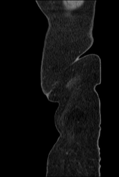 Brown tumors compressing the spinal cord (Radiopaedia 68442-77988 F 1).jpg
