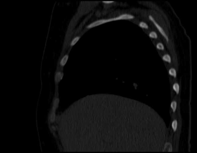 Brown tumors compressing the spinal cord (Radiopaedia 68442-77988 Sagittal bone window 16).jpg