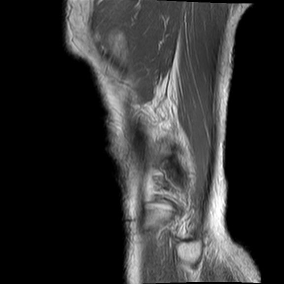 File:Bucket handle tear - medial meniscus (Radiopaedia 29250-29664 Sagittal PD 1).jpg