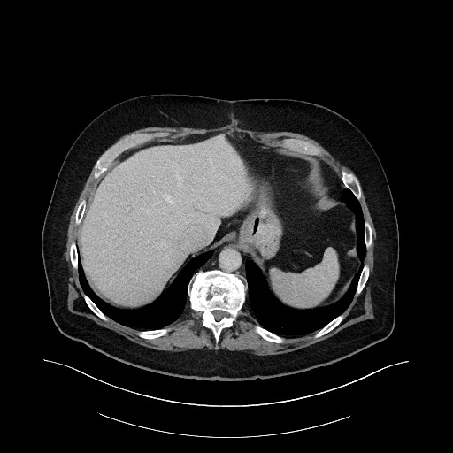 Buried bumper syndrome - gastrostomy tube (Radiopaedia 63843-72575 A 4).jpg