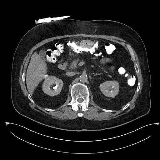 Buried bumper syndrome - gastrostomy tube (Radiopaedia 63843-72577 Axial Inject 34).jpg
