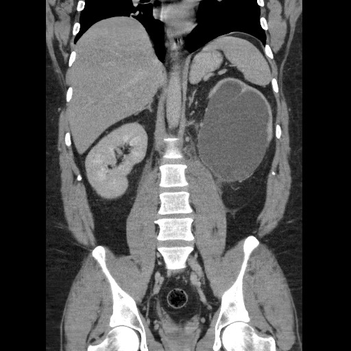 Burned-out testicular seminoma - retroperitoneal nodal metastases (Radiopaedia 62872-71245 B 42).jpg