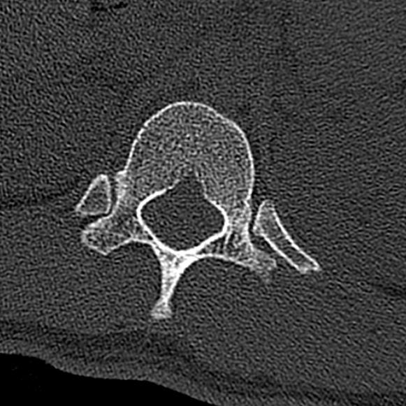 Burst fracture (Radiopaedia 53373-59357 Axial bone window 1).jpg
