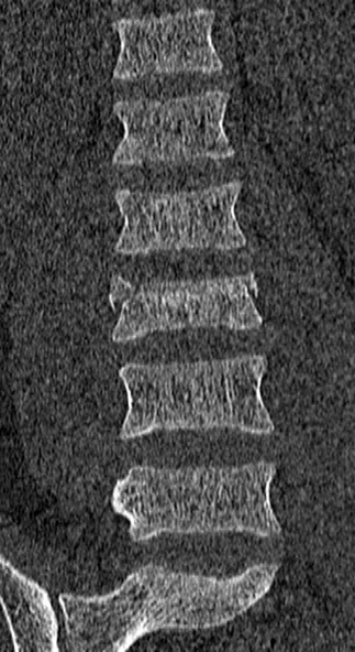 File:Burst fracture (Radiopaedia 53373-59357 Coronal bone window 25).jpg