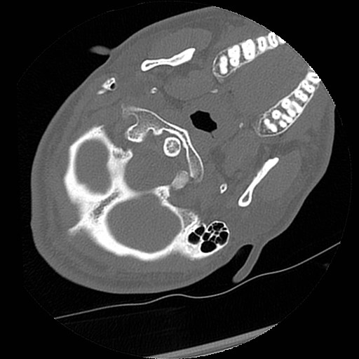 C1-C2 "subluxation" - normal cervical anatomy at maximum head rotation (Radiopaedia 42483-45607 Axial non-contrast 58).jpg