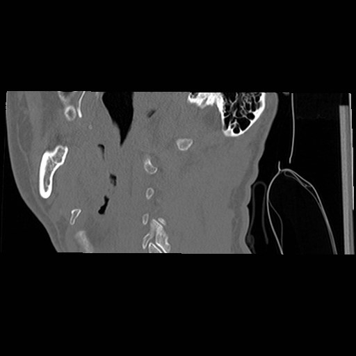 C1-C2 "subluxation" - normal cervical anatomy at maximum head rotation (Radiopaedia 42483-45607 C 58).jpg