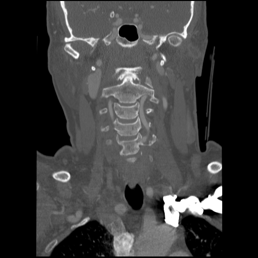 C1 anterior arch (plough) fracture - type 1 (Radiopaedia 76181-87720 Coronal bone window 60).jpg