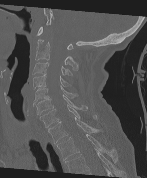 C2 fracture with vertebral artery dissection (Radiopaedia 37378-39199 Sagittal bone window 37).png
