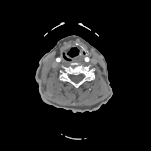 File:C2 fracture with vertebral artery dissection (Radiopaedia 37378-39200 A 121).png