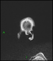 CNS manifestations of NF1 - optic pathway glioma, neurofibroma, dural ectasia (Radiopaedia 37874-39805 Sagittal FLAIR 5).jpg