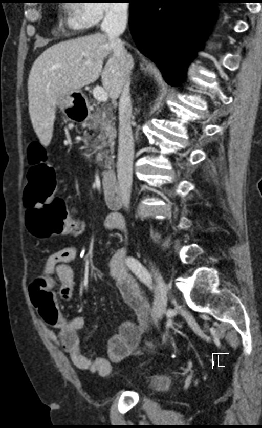 Calcified adrenal glands and Spigelian hernia (Radiopaedia 49741-54988 C 95).jpg