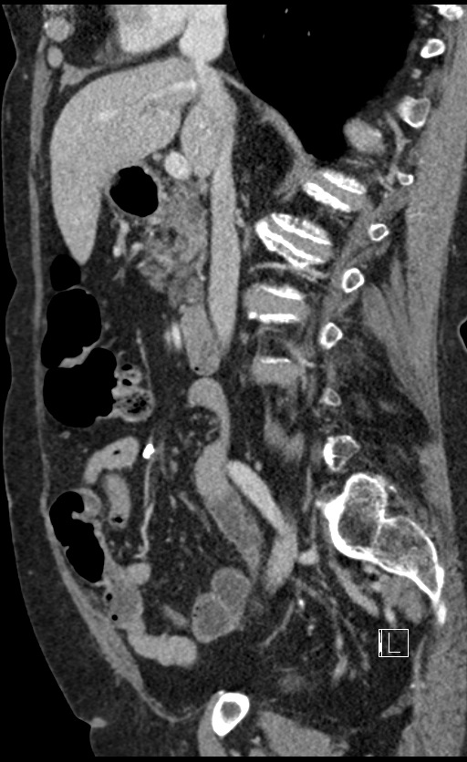 Calcified adrenal glands and Spigelian hernia (Radiopaedia 49741-54988 C 96).jpg