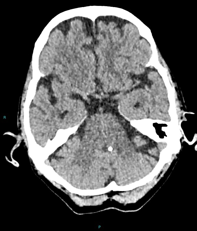 Calcified cerebral emboli from left ventricular thrombus (Radiopaedia 84420-99758 Axial non-contrast 67).jpg