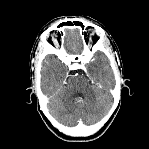 Calcified cerebral hydatid cyst (Radiopaedia 65603-74717 Axial with contrast 19).jpg