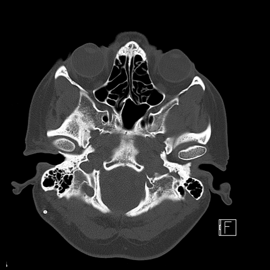 Calcified chronic subdural hematoma (Radiopaedia 77374-89492 Axial bone window 16).jpg