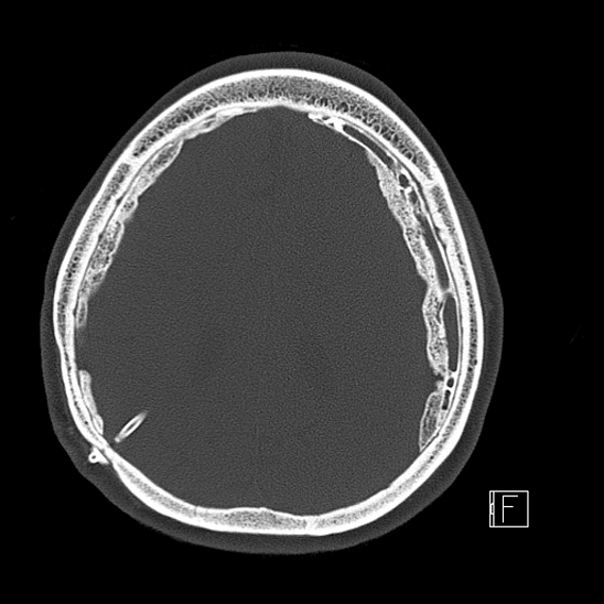 Calcified chronic subdural hematoma (Radiopaedia 77374-89492 Axial bone window 95).jpg