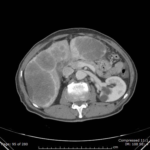 Calcified liver metastases (Radiopaedia 44699-48470 B 34).jpg