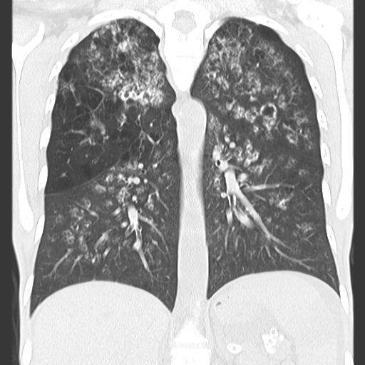 File:Calciphylaxis and metastatic pulmonary calcification (Radiopaedia 10887-11318 Coronal lung window 9).jpg