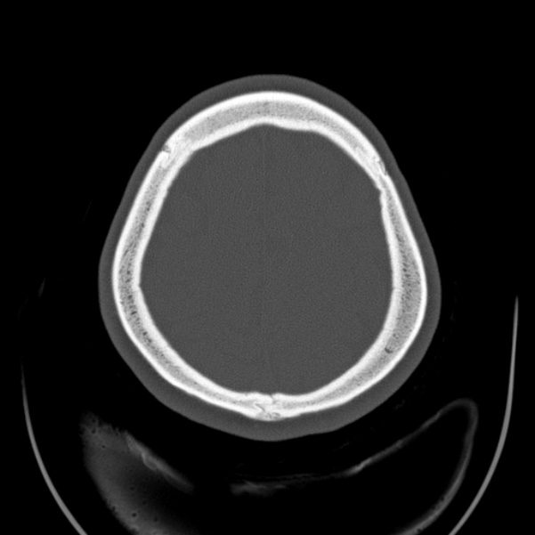 Calvarial osteoma (Radiopaedia 36520-38079 Axial bone window 89).jpg