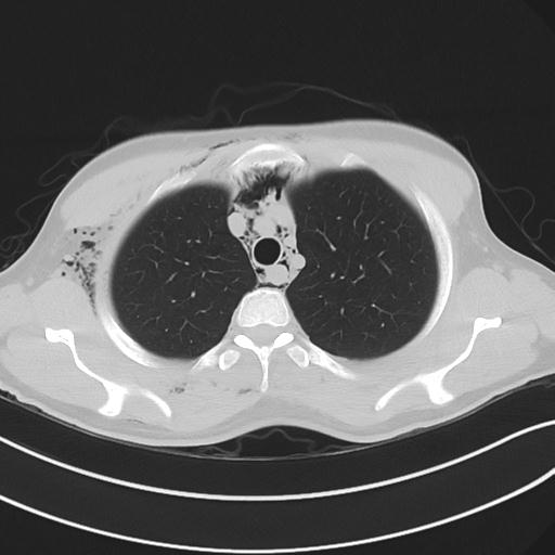 File:Cannabis ('bong') smoking induced pneumomediastinum and subcutaneous emphysema (Radiopaedia 29947-30479 C 26).jpg