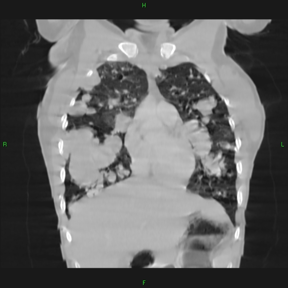 File:Cannon ball metastases - synovial sarcoma (Radiopaedia 26135-26271 Coronal lung window 4).jpg