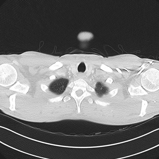 File:Cannonball metastases - testicular choriocarcinoma (Radiopaedia 84510-99891 Axial lung window 10).jpg