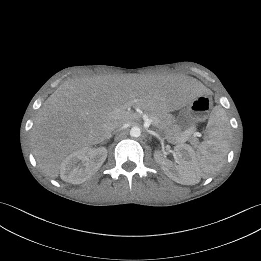 Cannonball metastases - testicular choriocarcinoma (Radiopaedia 84510-99891 B 111).jpg
