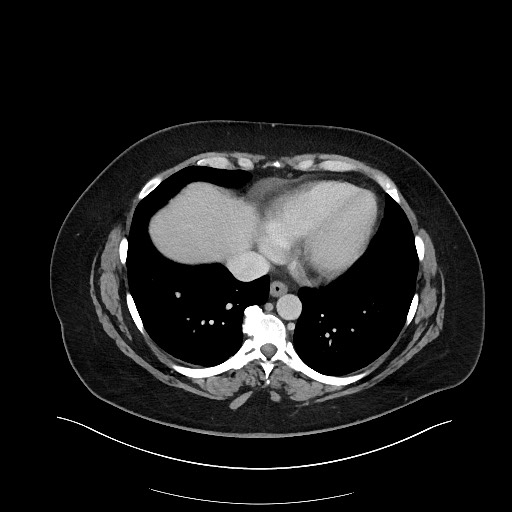 Carcinoid tumor - terminal ileum (Radiopaedia 60931-68739 A 10).jpg