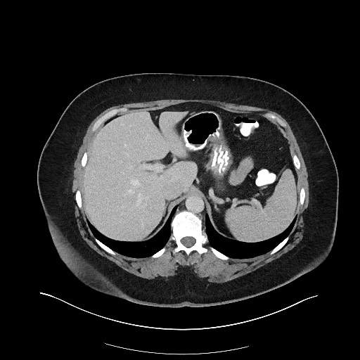 Carcinoid tumor - terminal ileum (Radiopaedia 60931-68739 A 31).jpg