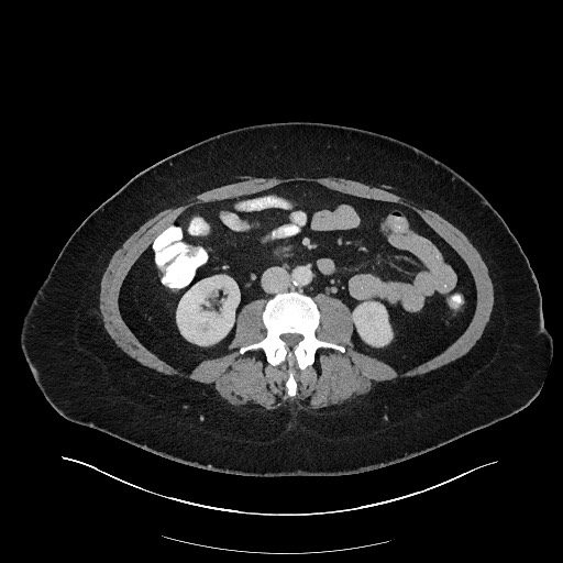 Carcinoid tumor - terminal ileum (Radiopaedia 60931-68739 A 69).jpg