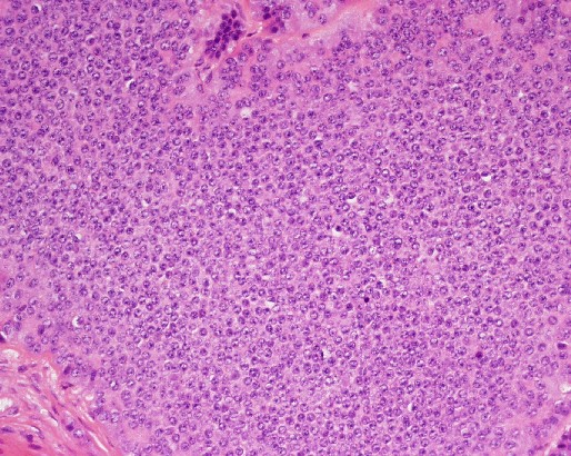 File:Carcinoid tumor of the ileum with metastasis to orbit (Radiopaedia 28165-28426 B 1).jpg