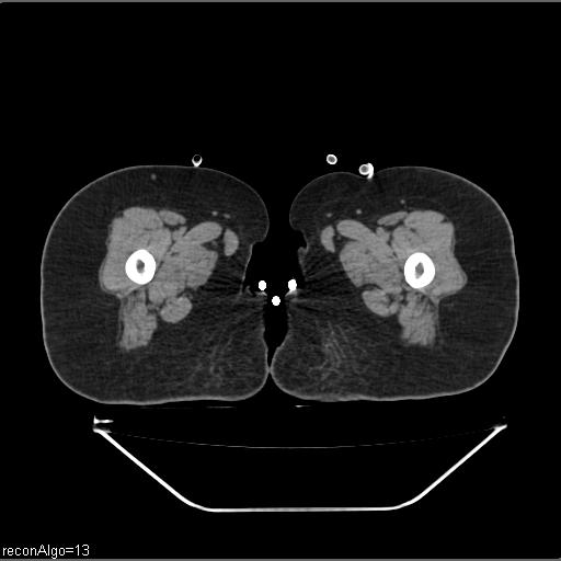 File:Carcinoma cervix- brachytherapy applicator (Radiopaedia 33135-34173 Axial non-contrast 68).jpg