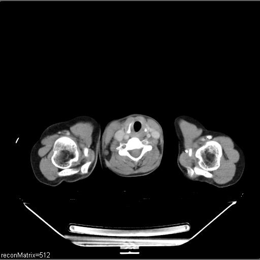 File:Carcinoma of esophagus (Radiopaedia 27356-27550 A 35).jpg