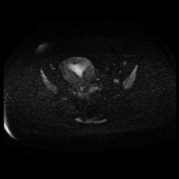 Carcinoma of the cervix (Radiopaedia 89018-105858 Axial DWI 56).jpg