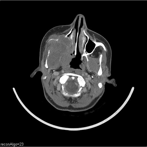 File:Carcinoma of the maxillary antrum (Radiopaedia 53805-59888 Axial C+ delayed 51).jpg