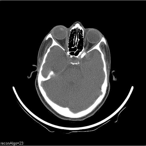 Carcinoma of the maxillary antrum (Radiopaedia 53805-59888 Axial non-contrast 73).jpg