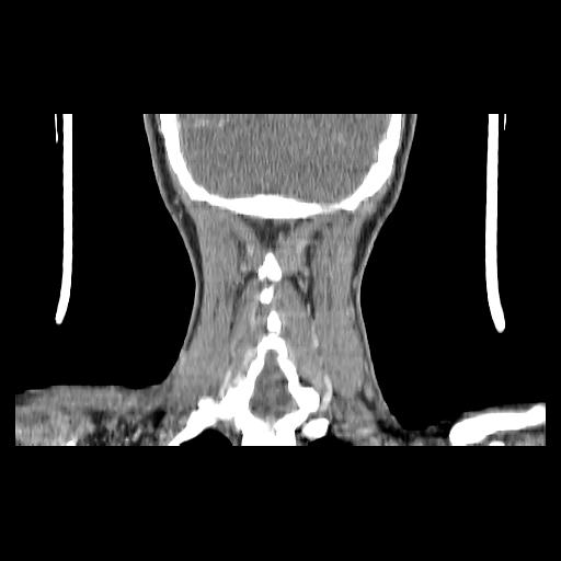 Carcinoma of the maxillary antrum (Radiopaedia 53805-59888 Coronal C+ delayed 140).jpg