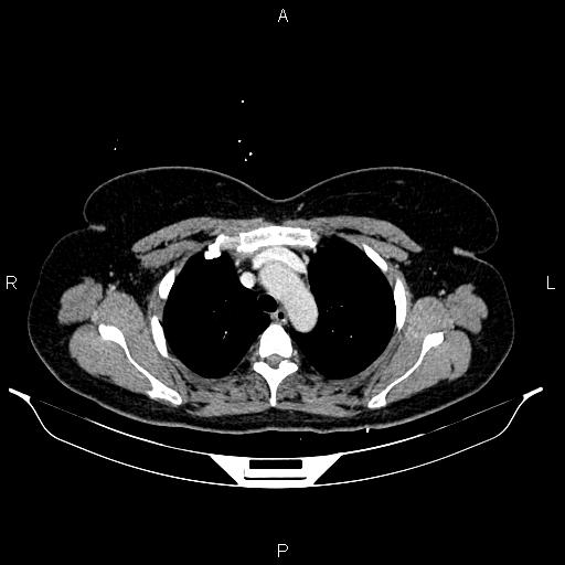 Carcinoma of uterine cervix (Radiopaedia 85861-101700 A 12).jpg