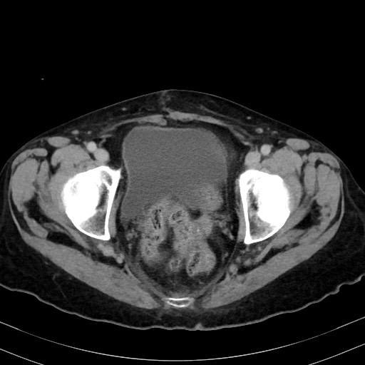 Carcinosarcoma (Radiopaedia 70401-80503 A 61).jpg