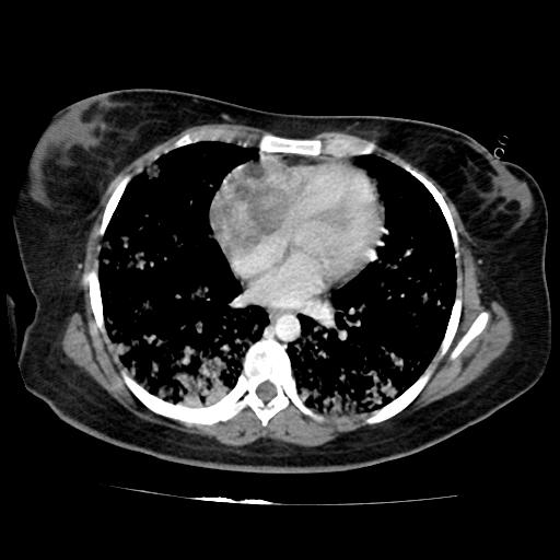 File:Cardiac angiosarcoma (Radiopaedia 66010-75181 B 112).jpg